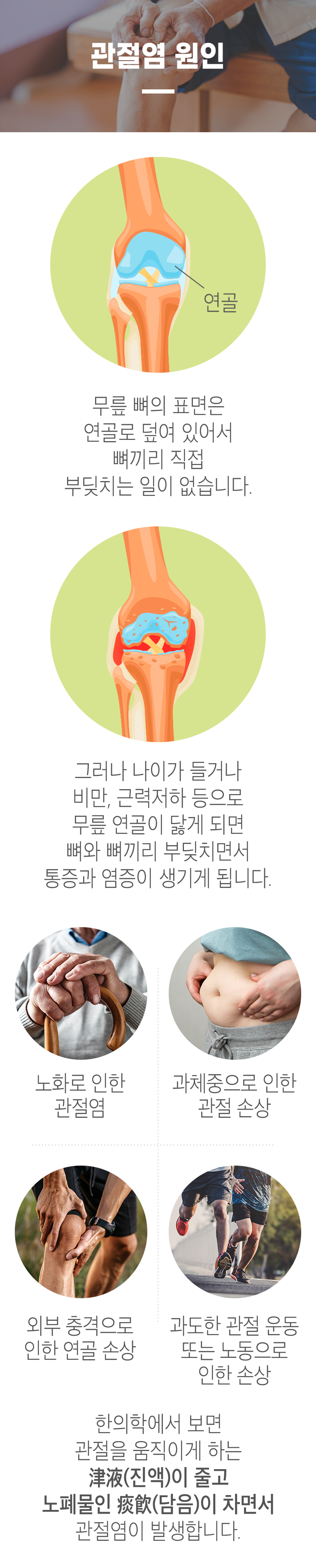 관절염 원인 ▷ 무릎 뼈의 표면은 연골로 덮여 있어서 뼈끼리 직접 부딪치는 일이 없습니다. 그러나 나이가 들거나 비만, 근력저하 등으로 무릎 연골이 닳게 되면 뼈와 뼈끼리 부딪히면서 통증과 염증이 생기게 됩니다. 노화로 인한 관절염, 과체중으로 인한 관절 손상, 외부 충격으로 인한 연골 손상, 과도한 관절 운동 또는 노동으로 인한 손상. 한의학에서 보면 관절을 움직이게 하는 津液(진액)이 줄고 노폐물인 痰飮)이 차면서 관절염이 발생합니다.