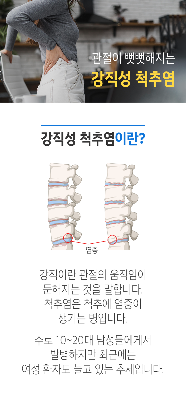 관절이 뻣뻣해지는 강직성 척추염. 강직성 척추염이란? ▷ 강직이란 관절의 움직임이 둔해지는 것을 말합니다. 척추염은 척추에 염증이 생기는 병입니다. 주로 10~20대 남성들에게서 발병하지만 최근에는 여성 환자도 늘고 있는 추세입니다.