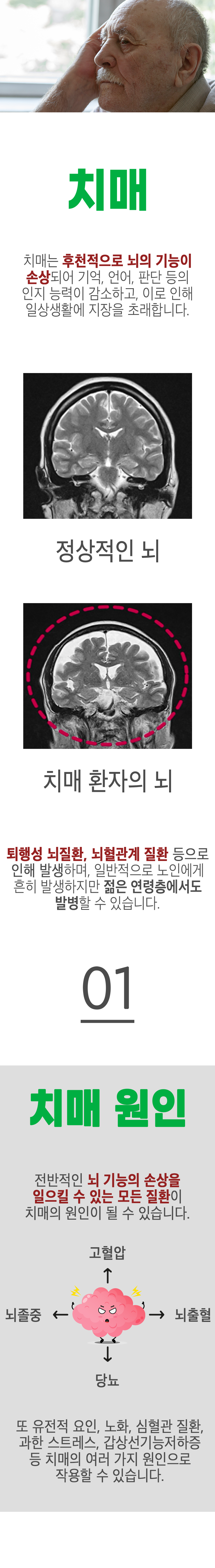 치매 ▷ 치매는 후천적으로 뇌의 기능이 손상되어 기억, 언어, 판단 등의 인지 능력이 감소하고, 이로 인해 일상생활에 지장을 초래합니다. 퇴행성 뇌질환, 뇌혈관계 질환 등으로 인해 발생하며, 일반적으로 노인에게 흔히 발생하지만 젊은 연령층에서도 발병할 수 있습니다. 01. 치매 원인 ▷ 전반적인 뇌 기능의 손상을 일으킬 수 있는 모든 질환이 치매의 원인이 될 수 있습니다. 또 유전적 요인, 노화, 심혈관 질환, 과한 스트레스, 갑상선기능저하증 등 치매의 여러 가지 원인으로 작용할 수 있습니다.