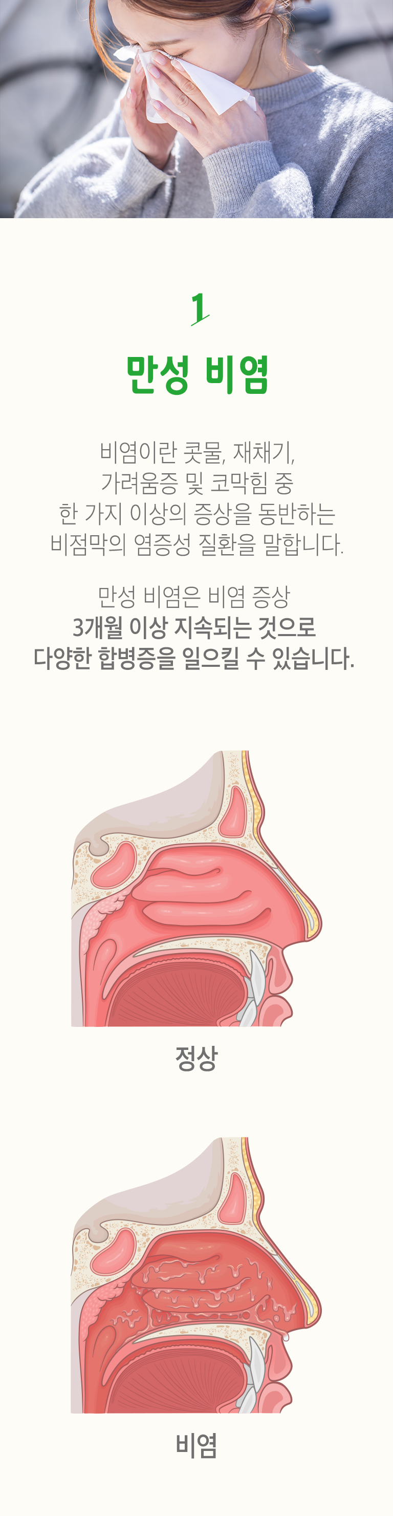 01 만성 비염 ▷ 비염이란 콧물, 재채기, 가려움증 및 코막힘 중 한 가지 이상의 증상을 동반하는 비점막의 염증성 질환을 말합니다. 만성 비염은 비염 증상 3개월 이상 지속되는 것으로 다양한 합병증을 일으킬 수 있습니다. 