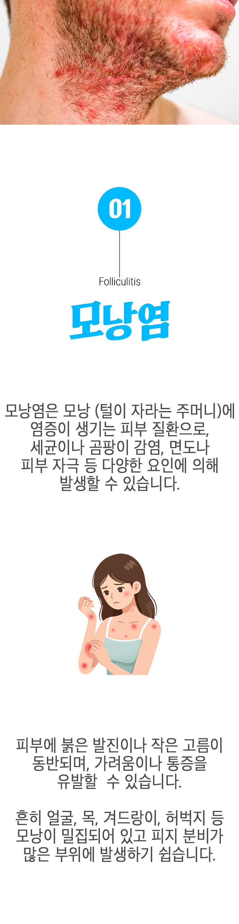 01 모낭염 ▷ 모낭염은 모낭(털이 자라는 주머니)에 염증이 생기는 피부 질환으로, 세균이나 곰팡이 감염, 면도나 피부 자극 등 다양한 요인에 의해 발생할 수 있습니다. 피부에 붉은 발진이나 작은 고름이 동반되며, 가려움이나 통증을 유발할 수 있습니다. 흔히 얼굴, 목, 겨드랑이, 허벅지 등 모낭이 밀집되어 있고 피지 분비가 많은 부위에 발생하기 쉽습니다.