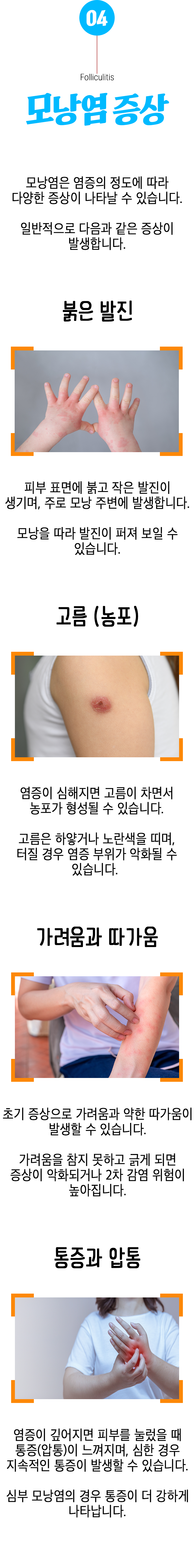 04 모낭염 증상 ▷ 모낭염은 염증의 정도에 따라 다양한 증상이 나타날 수 있습니다. 일반적으로 다음과 같은 증상이 발생합니다. 붉은 발진 ▶ 피부 표면에 붉고 작은 발진이 생기며, 주로 모낭 주변에 발생합니다. 모낭을 따라 발진이 퍼져 보일 수 있습니다. 고름(농포) ▶ 염증이 심해지면 고름이 차면서 농포가 형성될 수 있습니다. 고름은 하얗거나 노란색을 띠며, 터질 경우 염증 부위가 악화될 수 있습니다. 가려움과 따가움 ▶ 초기 증상으로 가려움과 약한 따가움이 발생할 수 있습니다. 가려움을 참지 못하고 긁게 되면 증상이 악화되거나 2차 감염 위험이 높아집니다. 통증과 압통 ▶ 염증이 깊어지면 피부를 눌렀을 때 통증(압통)이 느껴지며, 심한 경우 지속적인 통증이 발생할 수 있습니다. 심부 모낭염의 경우 통증이 더 강하게 나타납니다.