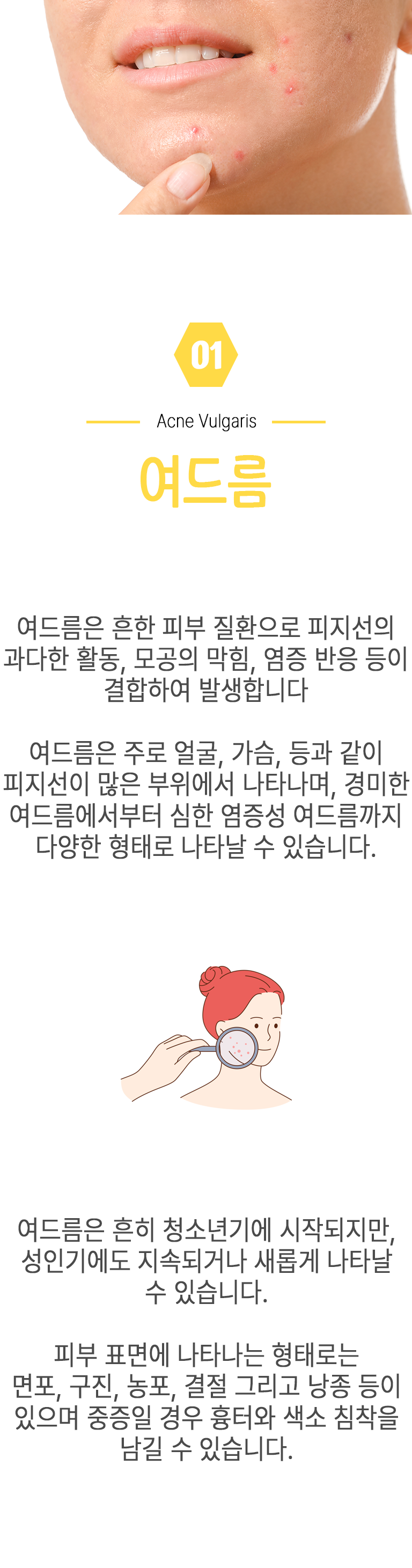 01 여드름 ▷ 여드름은 흔한 피부 질환으로 피지선의 과다한 활동, 모공의 막힘, 염증 반응 등이 결합하여 발생합니다. 여드름은 주로 얼굴, 가슴, 등과 같이 피지선이 많은 부위에서 나타나며, 경미한 여드름에서부터 심한 염증성 여드름까지 다양한 형태로 나타날 수 있습니다. 여드름은 흔히 청소년기에 시작되지만, 성인기에도 지속되거나 새롭게 나타날 수 있습니다. 피부 표면에 나타나는 형태로는 면포, 구진, 농포, 결절 그리고 낭종 등이 있으며 중증일 경우 흉터와 색소 침착을 남길 수 있습니다.