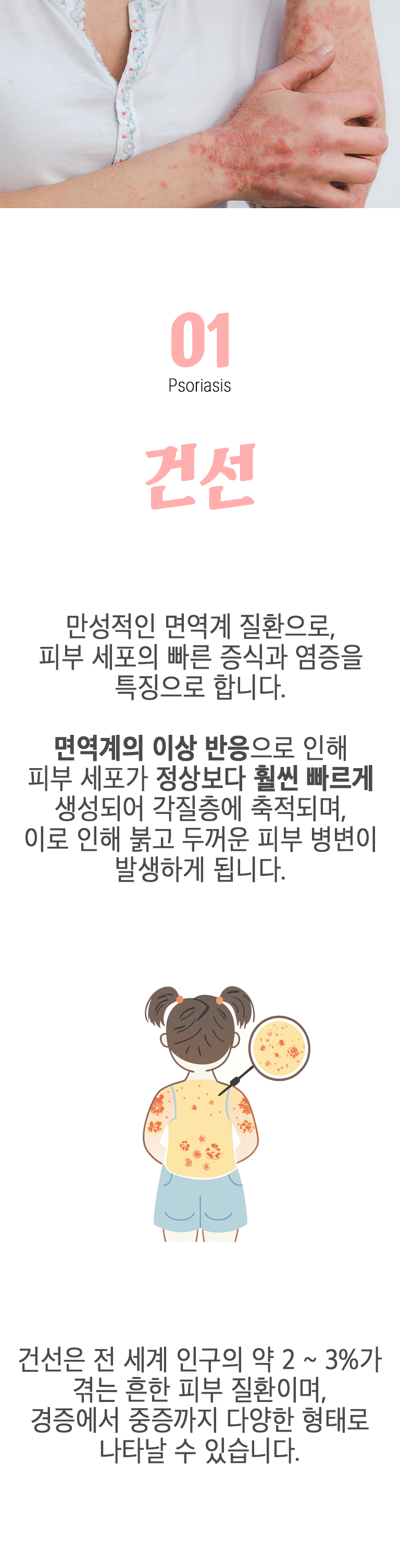 01 건선 ▷ 만성적인 면역계 질환으로, 피부 세포의 빠른 증식과 염증을 특징으로 합니다. 면역계의 이상 반응으로 인해 피부 세포가 정상보다 훨씬 빠르게 생성되어 각질층에 축적되며, 이로 인해 붉고 두꺼운 피부 병변이 발생하게 됩니다. 건선은 전 세계 인구의 약 2~3%가 겪는 흔한 피부 질환이며, 경증에서 중증까지 다양한 형태로 나타날 수 있습니다.