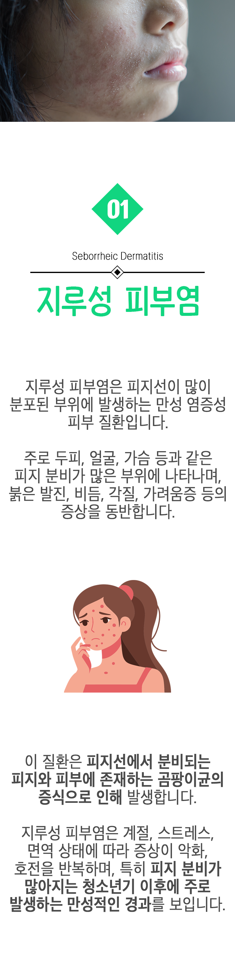 01 지루성 피부염 ▷ 지루성 피부염은 피지선이 많이 분포된 부위에 발생하는 만성 염증성 피부 질환입니다. 주로 두피, 얼굴, 가슴 등과 같은 피지 분비가 많은 부위에 나타나며, 붉은 발진, 비듬, 각질, 가려움증 등의 증상을 동반합니다. 이 질환은 피지선에서 분비되는 피지와 피부에 존재하는 곰팡이균의 증식으로 인해 발생합니다. 지루성 피부염은 계절, 스트레스, 면역 상태에 따라 증상이 악화, 호전을 반복하며, 특히 피지 분비가 많아지는 청소년기 이후에 주로 발생하는 만성적인 경과를 보입니다.