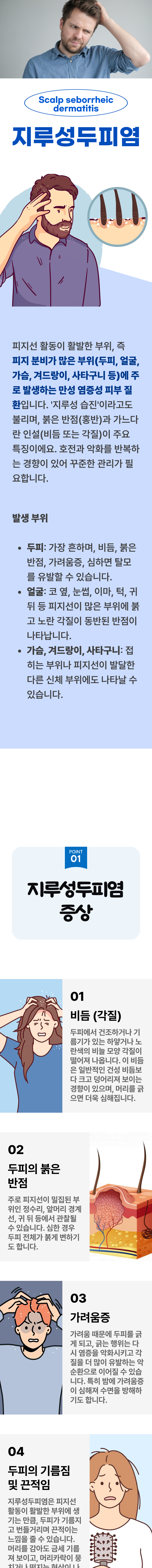 지루성두피염 1